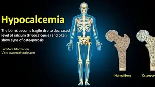 Treatment of hypocalcemia #AACCM