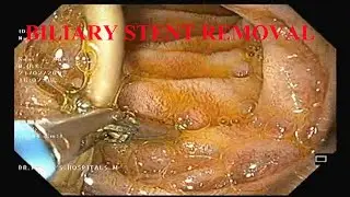 Biliary stent removal| Post ERCP status| Dr. Pandiaraja| Gastroenterology