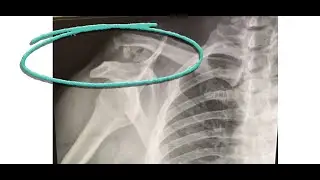 ELY Needs SURGERY!