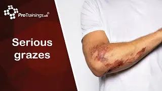 Serious Grazes