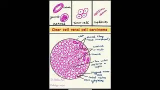 let's draw clear cell Renal cell carcinoma histology|easy step by step | very imp ✅ #microscopy