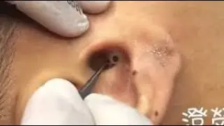 лечение прыщей   Удаление черных точек