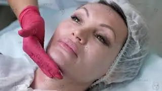 Тредлифтинг подбородка мезонитями Lift Line Nata