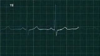 ECG plot with QRS beep, HR, grid