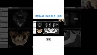 Implant Placement Tips