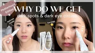 DARK SPOTS & DARK EYE CIRCLES (Motherhood edition) ft Caudalie Vinoperfect 🌱