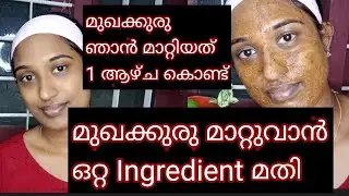 മുഖക്കുരു മാറ്റാം ഒരാഴ്ച്ചകൊണ്ട് II How To Remove Pimples