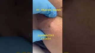 #skincare video out now Dr Khaled Sadek