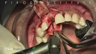 Mandibular Block Autograft for a Horizontal Ridge Deficiency with Followup and Implant Placement