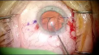 Exchange and Haptic Fixation (Yamane Technique) of RxSight Light Adjustable Lens