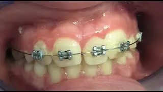 dente ectopico quasi concluso