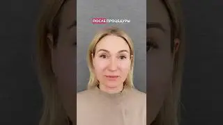 До и после процедуры FULLFACE