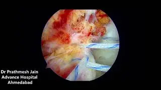 Repair Of Partial ACL tear  by Dr Prathmesh Jain. Advance Hospitals. No need of acl reconstruction.