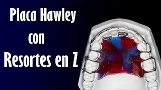 Placa Hawley con Resortes en Z | Elena Dental Art & More