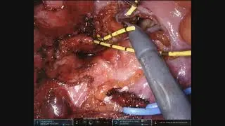 Total pelvic exenteration with en bloc side wall clearance and internal iliac artery resection