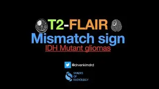 T2-FLAIR Mismatch sign