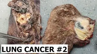 Lung cancer #2 - Central lung cancer