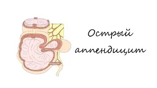 Острый аппендицит I патогенез I жалобы I лабораторная диагностика