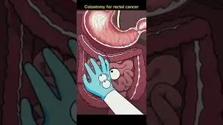 Colostomy for rectal cancer