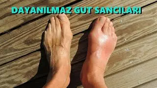 GUT HASTALIĞI NEDEN OLUR | Gut Hastalığı Nedir ?