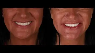 FP1 Immediate Load Maxillary Implant Case Using Pterygoid Implants