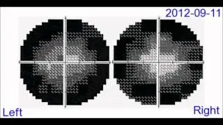Visual field tests, part 2