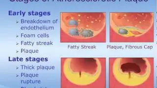 Acute Coronary Syndrome (ACS) - How it Happens