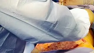 Diastasis Recti Repair by Dr Daniel Mills