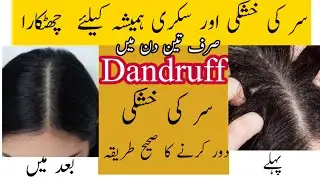hair fall solution at home | hair fall treatment | dandruff and hair fall treatment at home