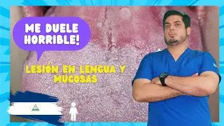 Mira como mejoró esta paciente las llagas en su boca con solo tres días!