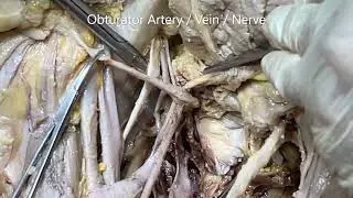 ILIAC ARTERY Divisions Branches in Pelvis and TRIANGLE OF DOOM with Clinicals – Sanjoy Sanyal