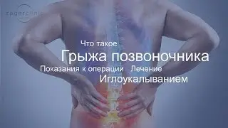 Что такое грыжа позвоночника | Лечение иглоукалыванием