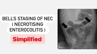 Bell's Staging of NEC - Necrotising Enterocolitis || Mis.Medicine #highyield