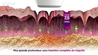 EXION RF Fractionnée: Comment ça fonctionne?