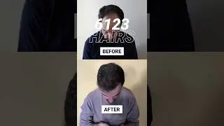 Hair Transplant On Norwood 4 Hair Loss