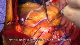 Right Coronary Aneurysm with Coronary Arteriovenous Fistula to Right Atrium