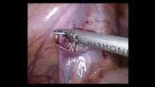 Laparoscopic varicoceles Dr. Biagio Orlandi MD Bari Italy