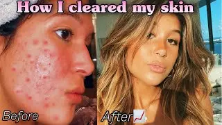 Going on accutane for 6 months- My Accutane Journey *pictures and results included!*