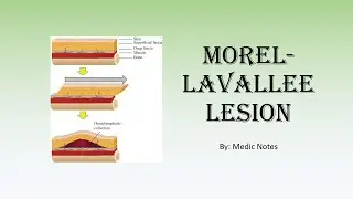 Morel-lavallee lesion - causes, signs and symptoms, investigation, treatment