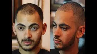 How To Fix Receding Hairline Naturally | No Pills, Spray Enhancements or tattoos