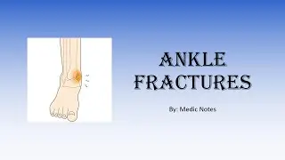 Ankle fractures - Lauge hansen classification, Danie weber classification, symptoms, treatment