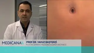 Karın Germe Ameliyatları Kimler İçin Yapılır?