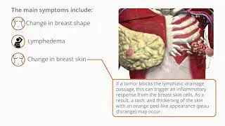 Diseases and Conditions: Symptoms of Breast Cancer