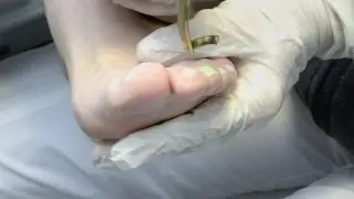 Nagelpilz Ursache und Behandlung - Neu