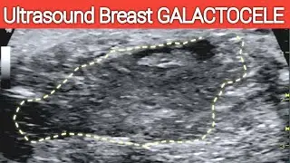 BREAST GALACTOCELE - Ultrasound | Breastfeeding Complication - Milk Cyst