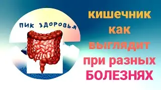 Кишечник. Как выглядит кишечник при разных болезнях#кишечник#болезнькишечника#онкология#рак#