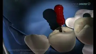 Рабердам, что это и для чего он нужен при лечении зуба