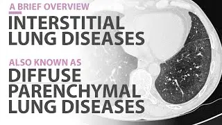 Interstitial Lung Diseases (ILD) or Diffuse Interstitial Lung Diseases (DPLDs)   A Brief Overview