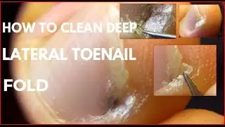 How to clean Deep lateral toenail fold