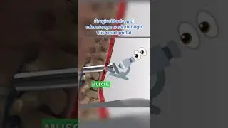 Disc Herniation Treatment (Minimally Invasive Microscope 🔬)